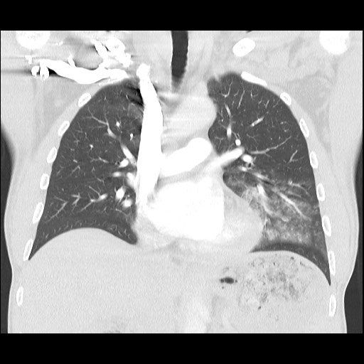 Accessory left horizontal fissure with lingular pneumonia (Radiopaedia 53763-59843 Coronal lung window 22).jpg