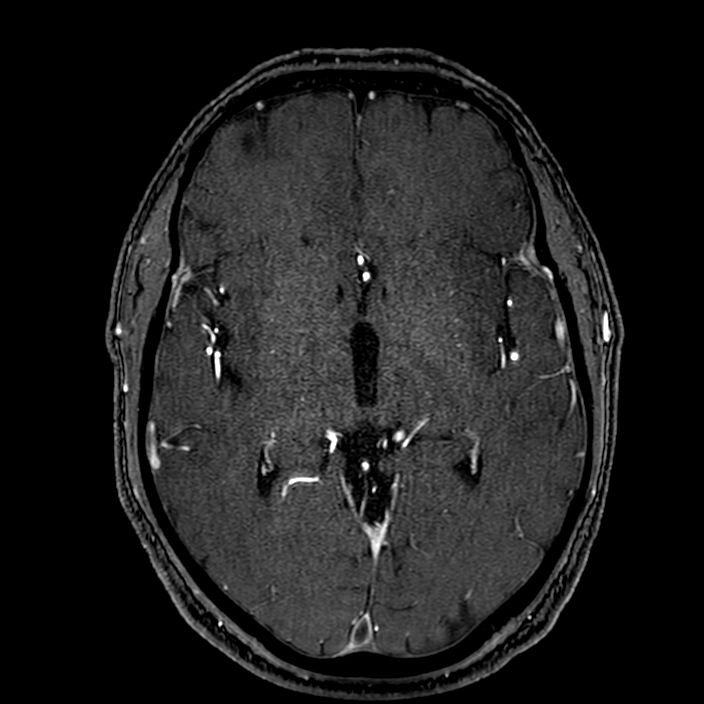 Accessory middle cerebral artery (Radiopaedia 73114-83828 Axial MRA 96).jpg