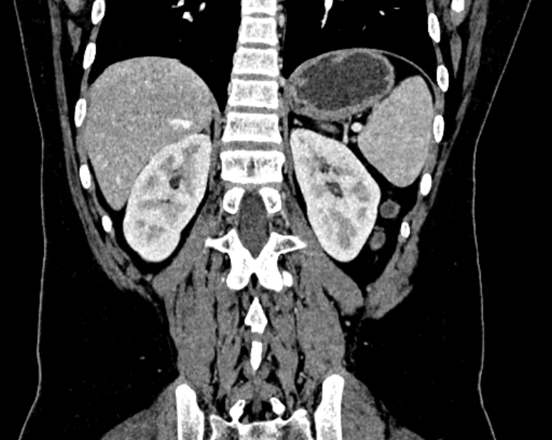 Accessory right inferior hepatic vein (Radiopaedia 75207-86305 Coronal C+ portal venous phase 57).jpg