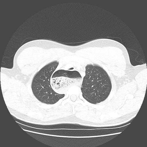 Achalasia (Radiopaedia 52507-58417 Axial lung window 13).jpg