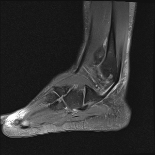 File:Achilles tendon tear (Radiopaedia 77615-89819 Sagittal PD fat sat 19).jpg
