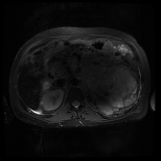 Acinar cell carcinoma of the pancreas (Radiopaedia 75442-86668 Axial T2 fat sat 32).jpg