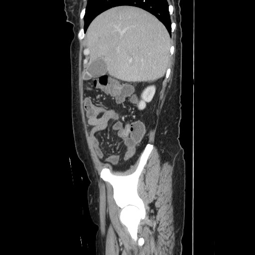 Acinar cell carcinoma of the pancreas (Radiopaedia 75442-86669 Sagittal C+ portal venous phase 53).jpg