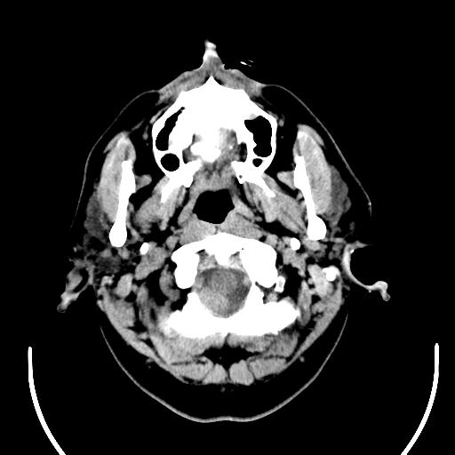 File:Acoustic schwannoma (Radiopaedia 29488-29982 AXIAL THICK non-contrast 2).jpg