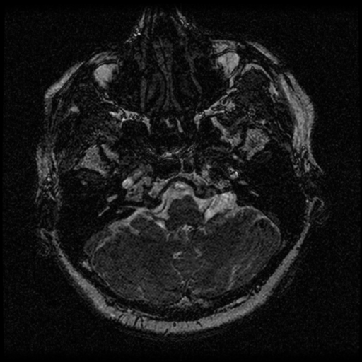 Acoustic schwannoma (Radiopaedia 33045-34060 Axial T2 10).png