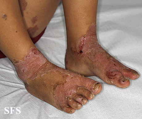 File:Acrodermatitis Enteropathica (Dermatology Atlas 38).jpg