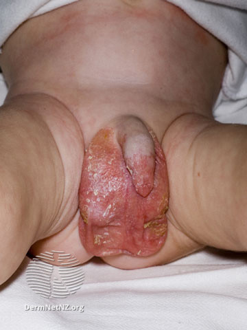 File:Acrodermatitis enteropathica (DermNet NZ systemic-acroderm3).jpg