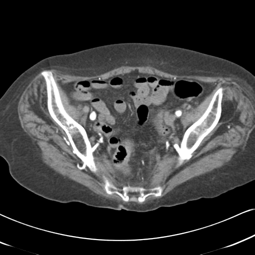 File:Active bleeding from duodenal ulcer with embolization (Radiopaedia 34216-35481 Axial C+ arterial phase 53).png