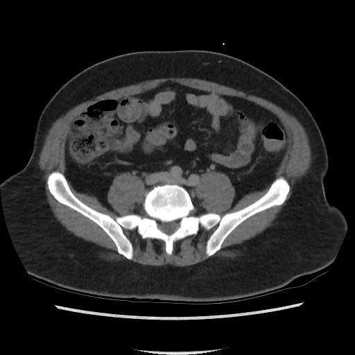 File:Active colonic bleed on CT (Radiopaedia 49765-55025 Axial C+ delayed 56).jpg