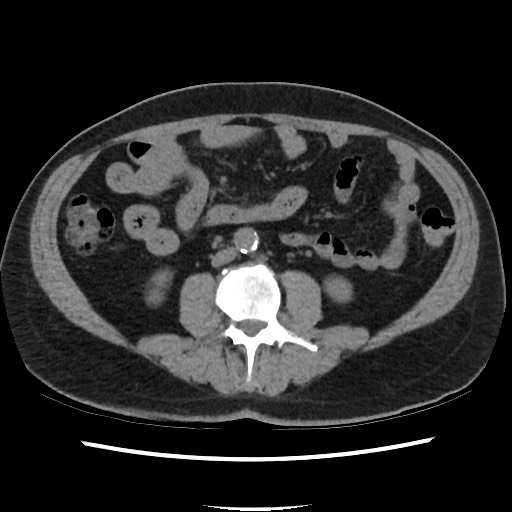 Active colonic bleed on CT (Radiopaedia 49765-55025 Axial non-contrast 42).jpg