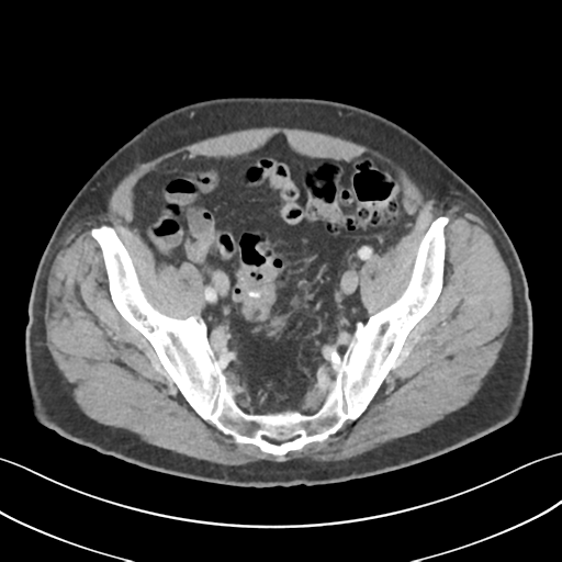 File:Active diverticular hemorrhage (Radiopaedia 39415-41725 Axial C+ portal venous phase 55).png