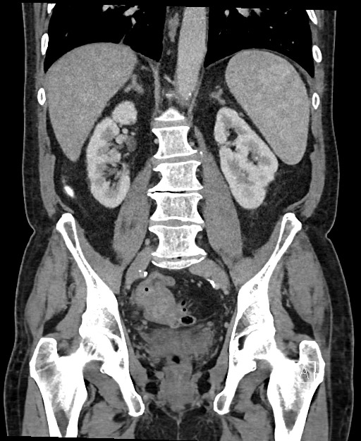 Active lower gastrointestinal bleeding - diverticular (Radiopaedia 61203-69106 Coronal C+ portal venous phase 86).jpg