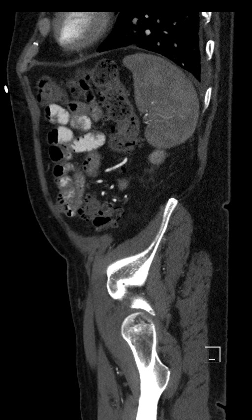 Active lower gastrointestinal bleeding - diverticular (Radiopaedia 61203-69106 Sagittal C+ arterial phase 29).jpg