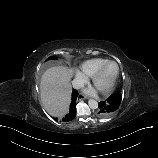 File:Active renal extravasation with large subcapsular and retroperitoneal hemorrhage (Radiopaedia 60975-68796 Axial 341).jpg