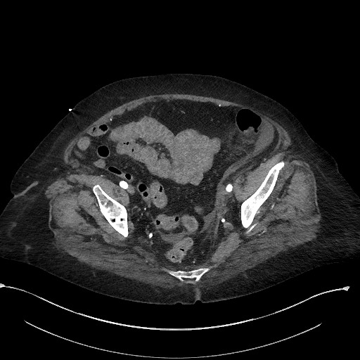 Active renal extravasation with large subcapsular and retroperitoneal hemorrhage (Radiopaedia 60975-68796 Axial C+ arterial phase 164).jpg