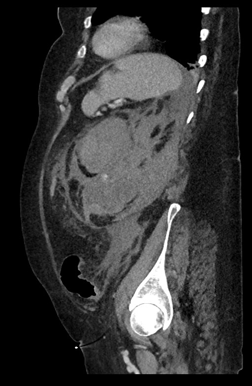 Active renal extravasation with large subcapsular and retroperitoneal hemorrhage (Radiopaedia 60975-68796 Sagittal C+ portal venous phase 70).jpg