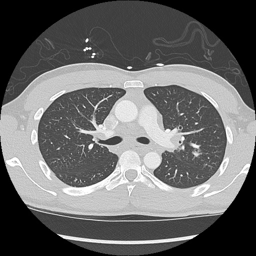File:Active right ventricular cardiac sarcoidosis (Radiopaedia 55596-62101 Axial lung window 15).jpg