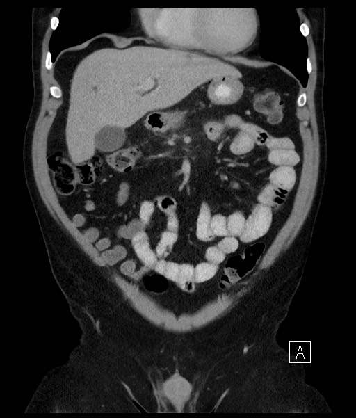 Acute-on-chronic pancreatitis (Radiopaedia 67286-76656 Coronal C+ portal venous phase 29).jpg