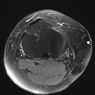 File:Acute-on-chronic transient lateral patellar dislocation with trochlear dysplasia (Radiopaedia 84099-99349 Axial PD fat sat 25).jpg