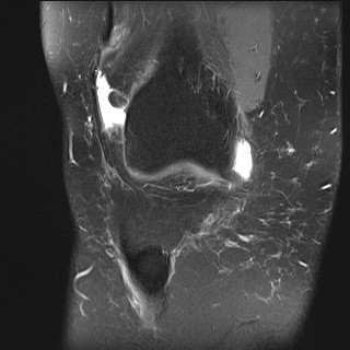 File:Acute-on-chronic transient lateral patellar dislocation with trochlear dysplasia (Radiopaedia 84099-99349 Coronal PD fat sat 28).jpg
