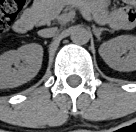 File:Acute L1 burst compression fracture (Radiopaedia 34430-35755 Axial non-contrast 11).png