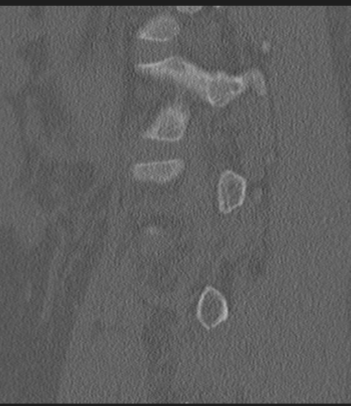 Acute L1 burst compression fracture (Radiopaedia 34430-35755 Sagittal bone window 18).png