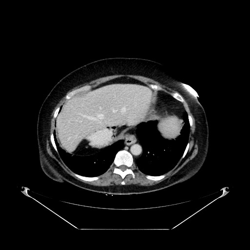 Acute appendicitis, heterotaxy syndrome (Radiopaedia 66884-76202 Axial C+ portal venous phase 21).jpg
