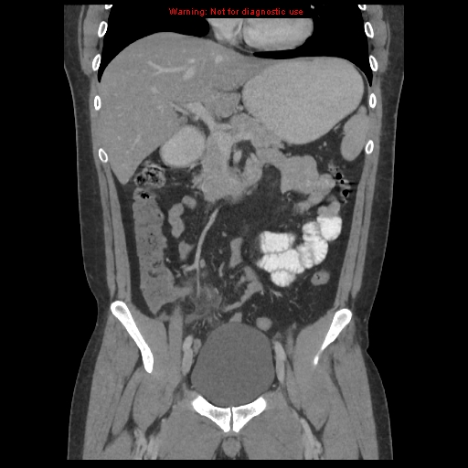 File:Acute appendicitis (Radiopaedia 10498-10973 F 13).jpg