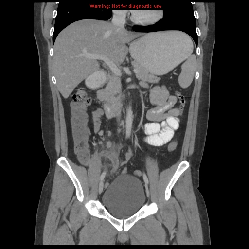 File:Acute appendicitis (Radiopaedia 10498-10973 F 16).jpg