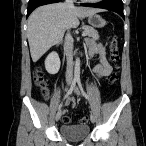 File:Acute appendicitis (Radiopaedia 38255-40270 Coronal C+ portal venous phase 43).jpg