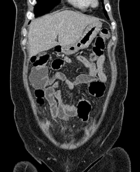 File:Acute appendicitis (Radiopaedia 48792-53822 Coronal C+ portal venous phase 69).jpg