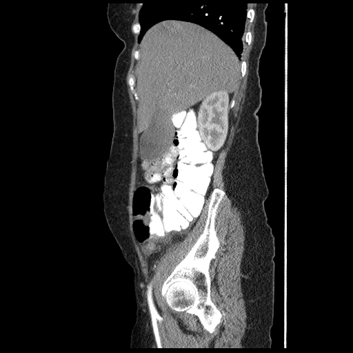 File:Acute appendicitis (Radiopaedia 52672-58589 Sagittal C+ arterial phase 28).jpg