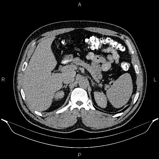 Acute appendicitis (Radiopaedia 84780-100240 Axial C+ delayed 28).jpg