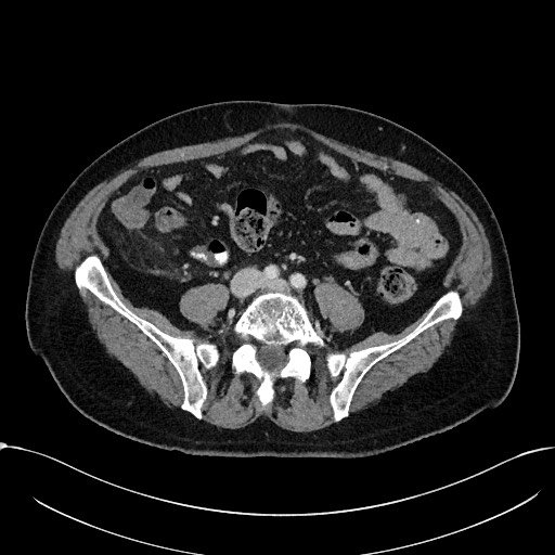 File:Acute appendicitis - large appendicoliths (Radiopaedia 61805-69820 Axial C+ portal venous phase 84).jpg