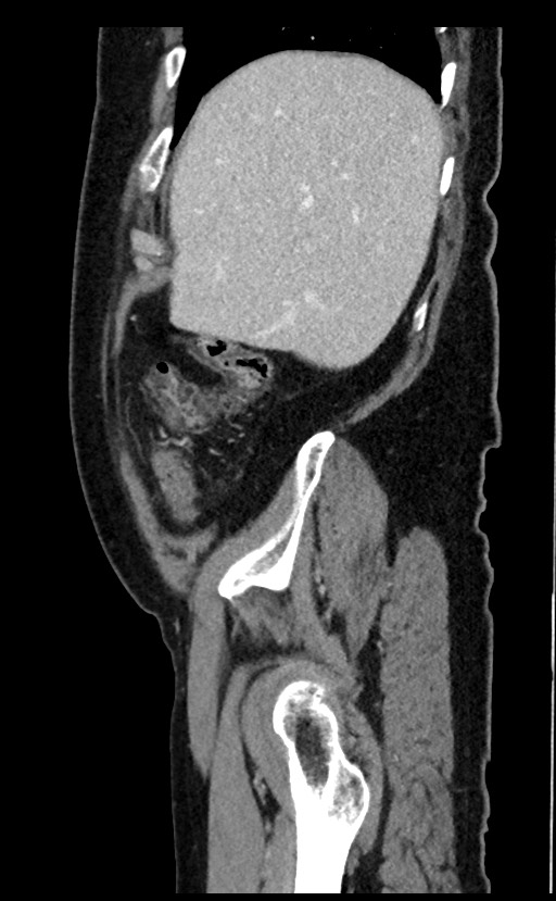 Acute appendicitis - large appendicoliths (Radiopaedia 61805-69820 Sagittal C+ portal venous phase 96).jpg