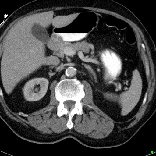 File:Acute appendicitis arising from a malrotated cecum (Radiopaedia 19970-19997 Axial C+ portal venous phase 4).jpg