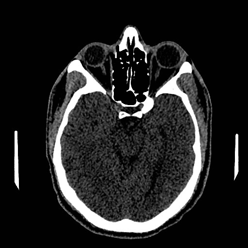 Acute basilar artery occlusion (Radiopaedia 43582-46985 Axial non-contrast 78).jpg
