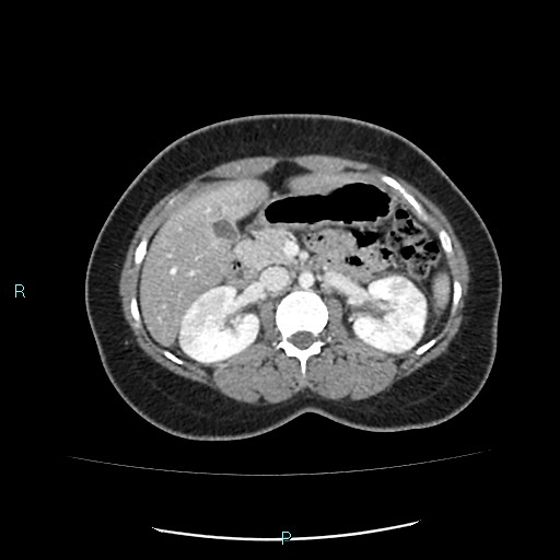 File:Acute bilateral pyelonephritis (Radiopaedia 37146-38881 Axial C+ portal venous phase 41).jpg