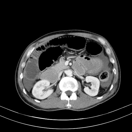 Acute bowel ischemia (Radiopaedia 87695-104114 Axial C+ portal venous phase 33).jpg