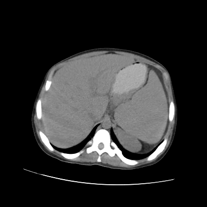 File:Acute calculous cholecystitis in patient with osteopetrosis (Radiopaedia 77871-90159 Axial non-contrast 23).jpg