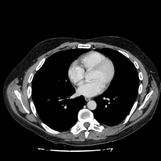 Acute cholecystitis and incidental left sided IVC (Radiopaedia 49352-54459 Axial C+ portal venous phase 12).jpg