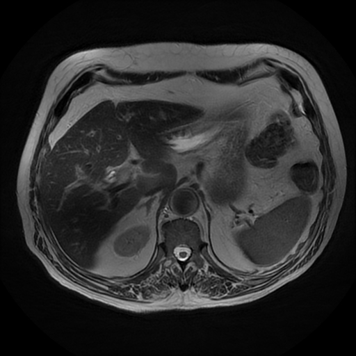 File:Acute cholecystitis complicated by pylephlebitis (Radiopaedia 65782-74915 Axial T2 14).jpg