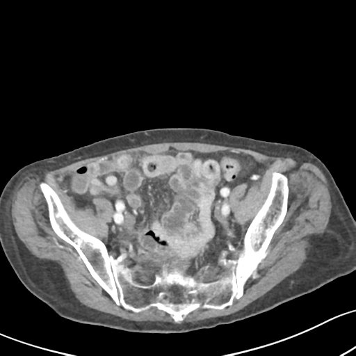 Acute cholecystitis with contained perforation (Radiopaedia 47328-51907 Axial C+ portal venous phase 57).png