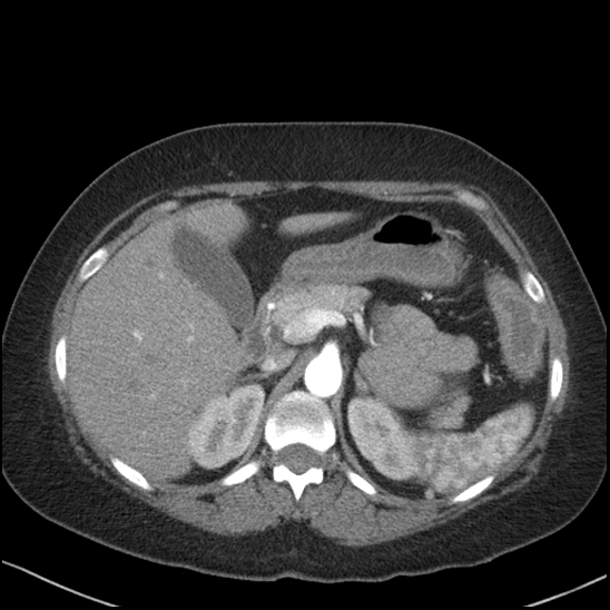 Acute colonic hemorrhage in ulcerative colitis (Radiopaedia 77415-89538 Axial C+ arterial phase 37).jpg