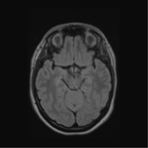 Acute disseminated encephalomyelitis (ADEM) (Radiopaedia 38073-40065 Axial FLAIR 24).png