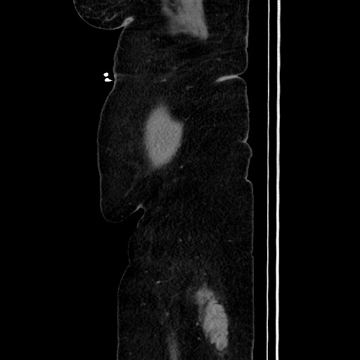 Acute diverticulitis - transverse colon (Radiopaedia 87063-103327 Sagittal C+ portal venous phase 40).jpg