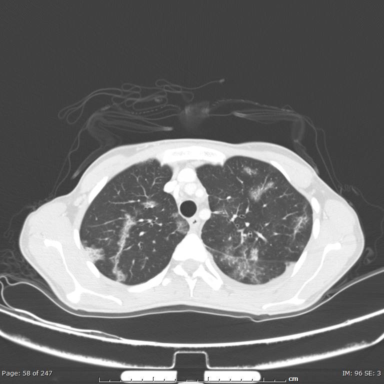 Acute eosinophilic pneumonia (Radiopaedia 48211-53073 Axial lung window 21).jpg