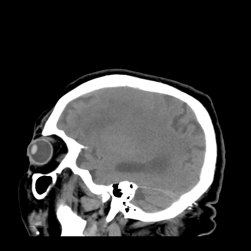 File:Acute hemorrhagic stroke (Radiopaedia 17507-17223 Sagittal non-contrast 35).jpg