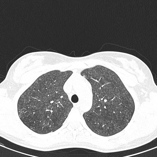 File:Acute hypersensitivity pneumonitis (Radiopaedia 85293-100870 Axial lung window 30).jpg