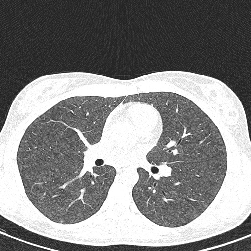 File:Acute hypersensitivity pneumonitis (Radiopaedia 85293-100870 Axial lung window 56).jpg